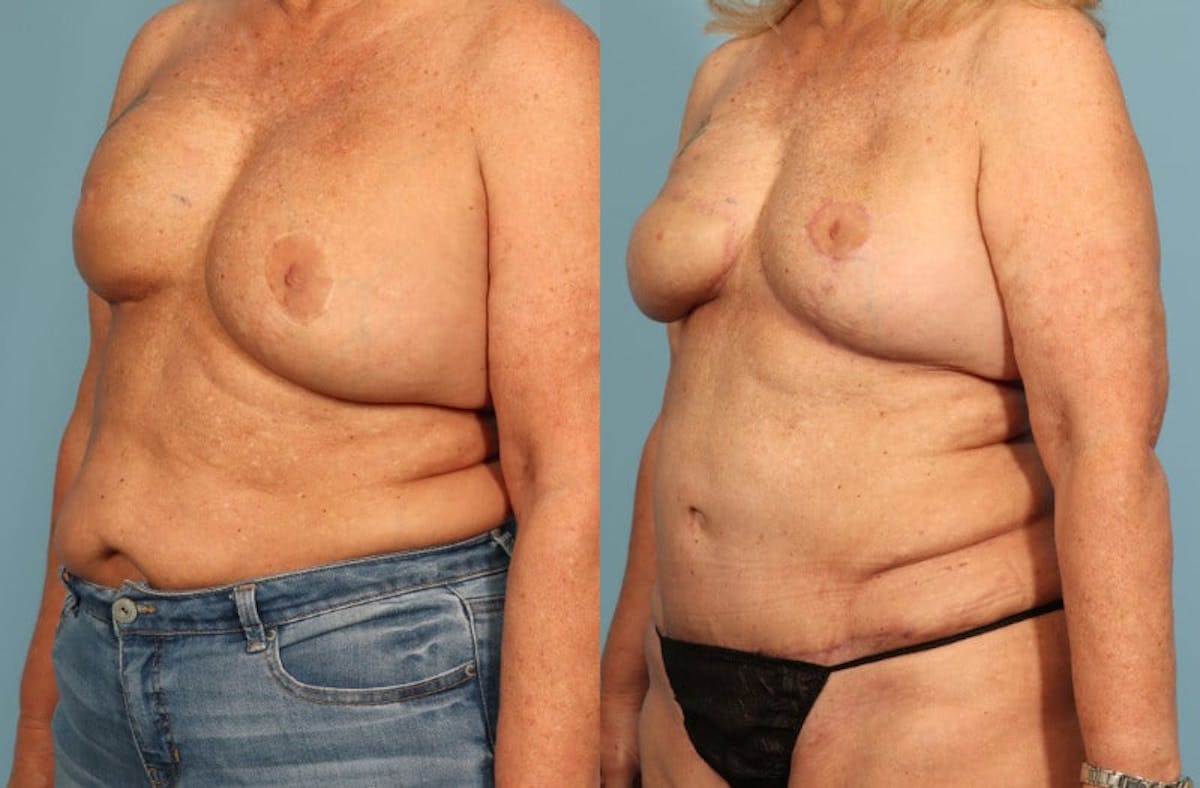 DIEP Flap Reconstruction Before & After Gallery - Patient 343553 - Image 3