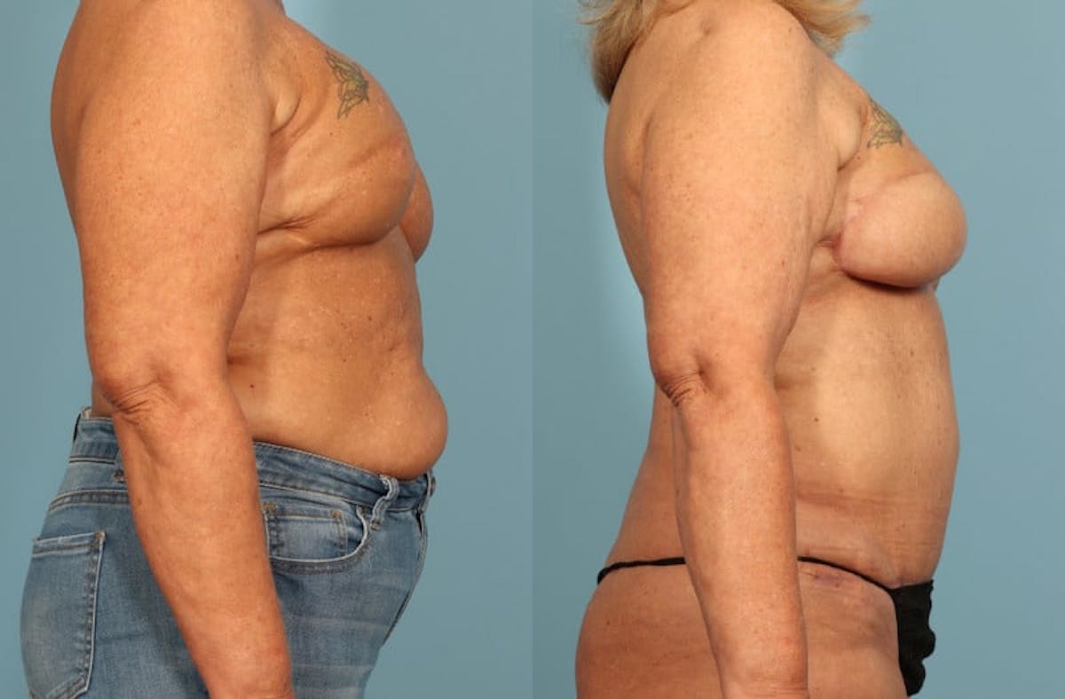 DIEP Flap Reconstruction Before & After Gallery - Patient 343553 - Image 4