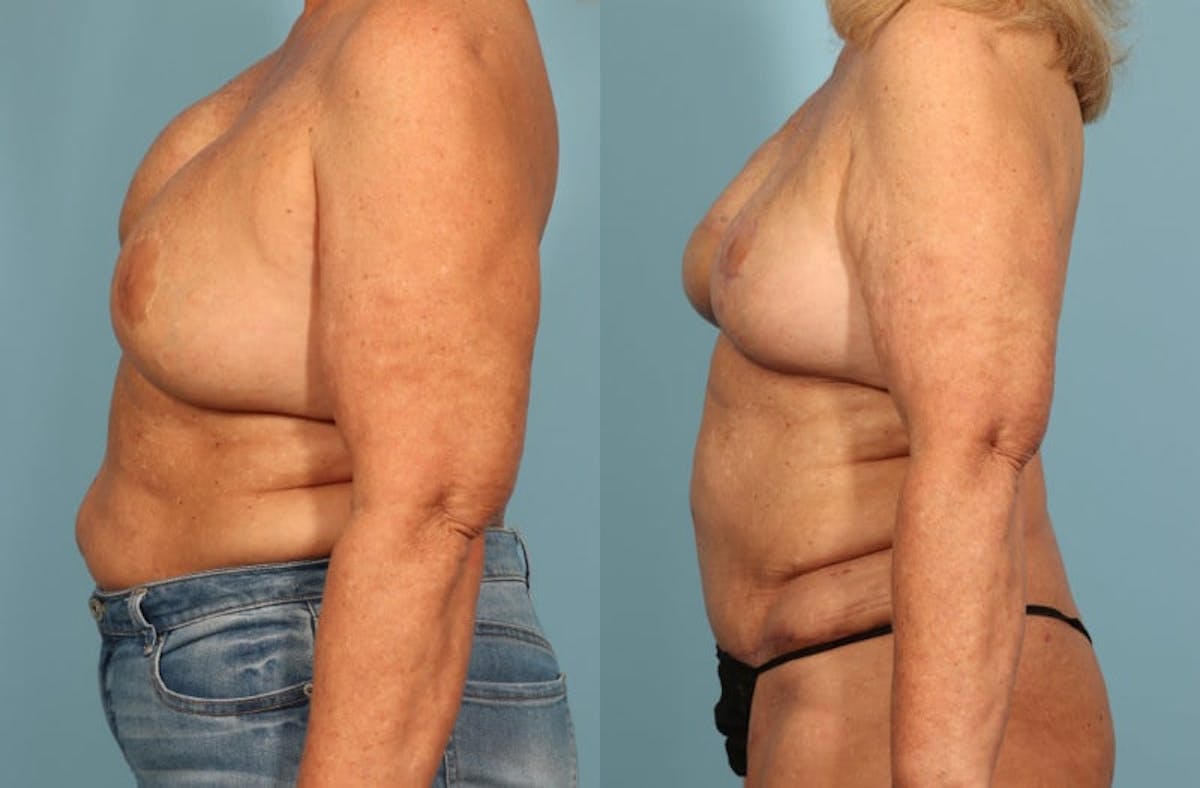 DIEP Flap Reconstruction Before & After Gallery - Patient 343553 - Image 5