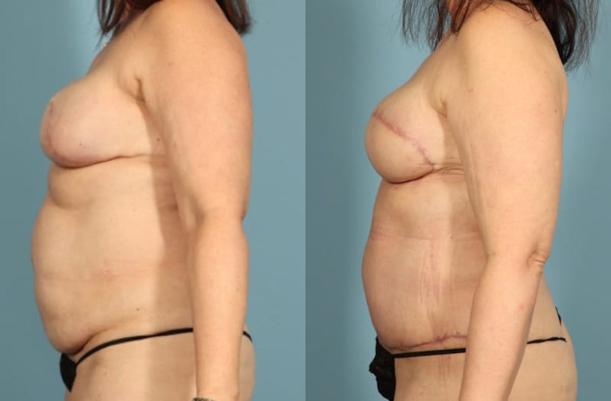 DIEP Flap Reconstruction Before & After Gallery - Patient 750234 - Image 5