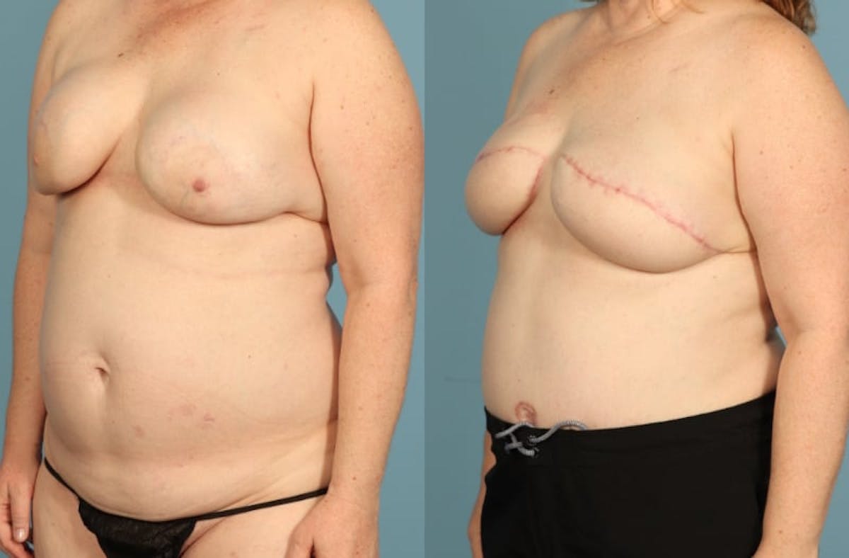 DIEP Flap Reconstruction Before & After Gallery - Patient 303019 - Image 2