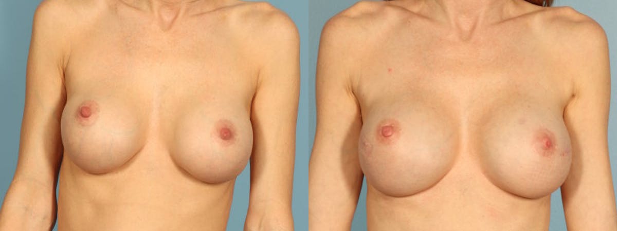 Genetic Mutations Before & After Gallery - Patient 162737 - Image 1