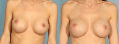 Genetic Mutations Before & After Gallery - Patient 162737 - Image 1