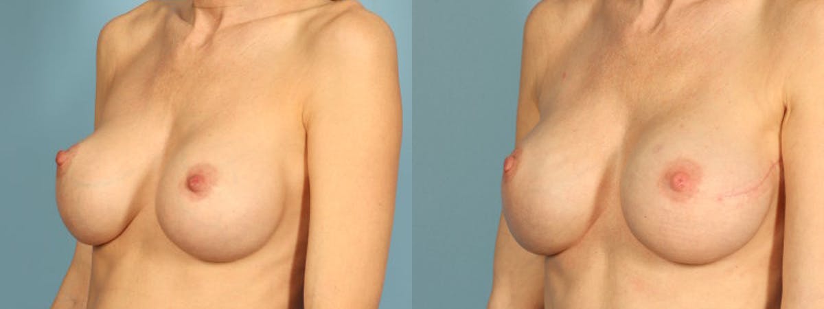 Genetic Mutations Before & After Gallery - Patient 162737 - Image 2