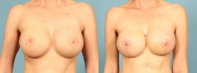 Genetic Mutations Before & After Gallery - Patient 332157 - Image 1