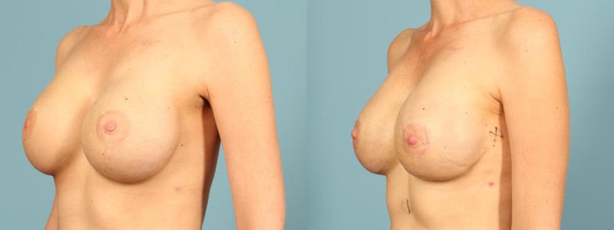 Genetic Mutations Before & After Gallery - Patient 332157 - Image 2