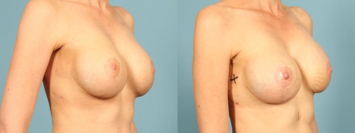 Genetic Mutations Before & After Gallery - Patient 332157 - Image 3