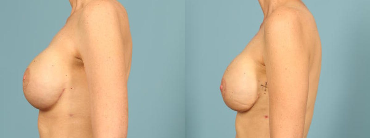 Genetic Mutations Before & After Gallery - Patient 332157 - Image 4