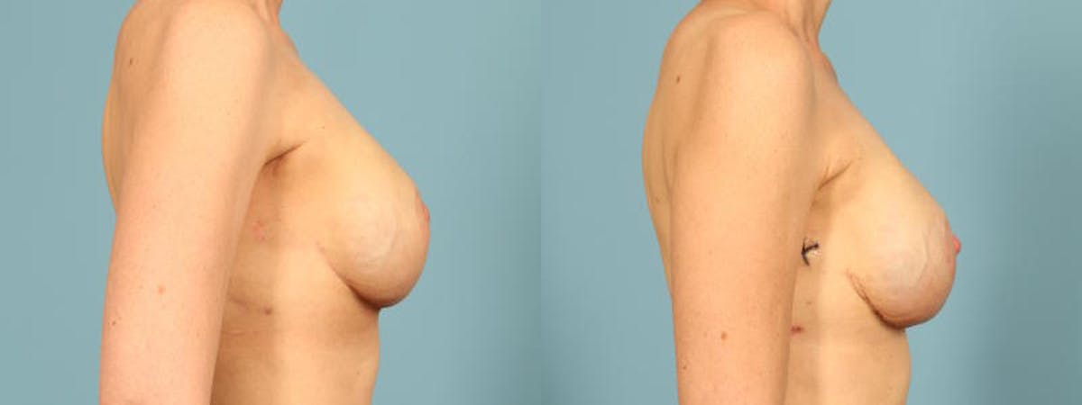 Genetic Mutations Before & After Gallery - Patient 332157 - Image 5