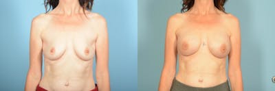Genetic Mutations Before & After Gallery - Patient 275869 - Image 1
