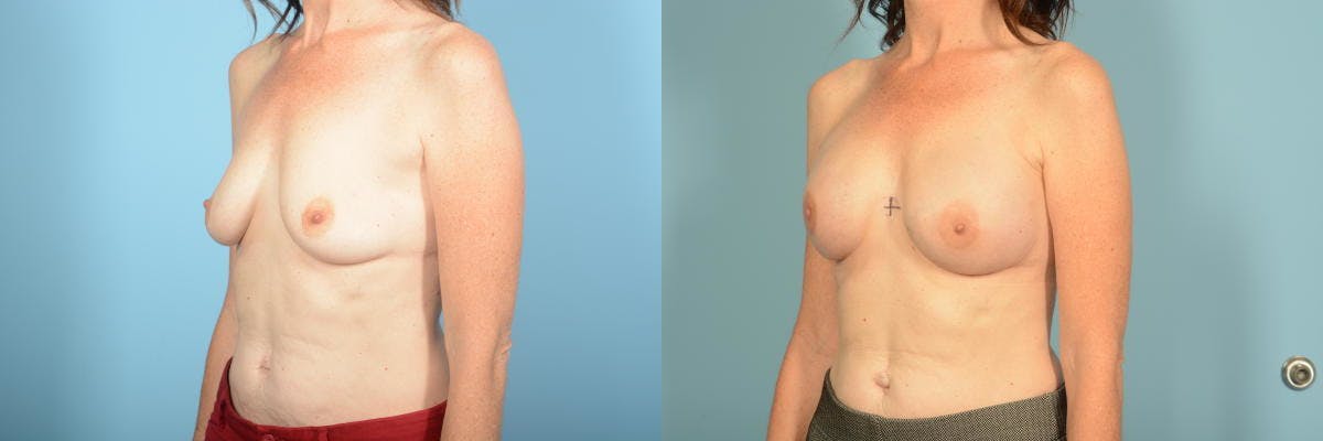 Genetic Mutations Before & After Gallery - Patient 275869 - Image 2