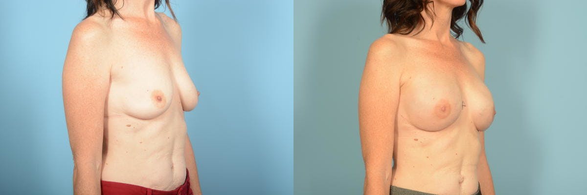 Genetic Mutations Before & After Gallery - Patient 275869 - Image 3