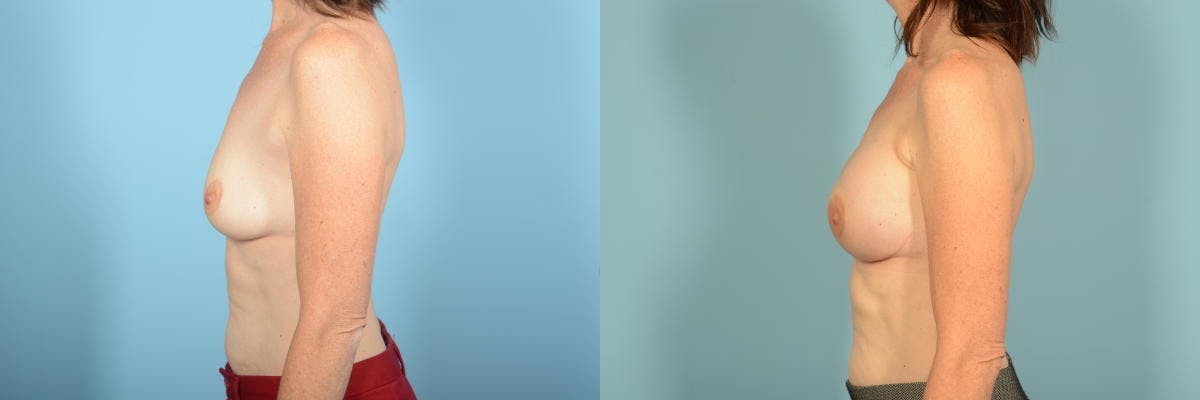 Genetic Mutations Before & After Gallery - Patient 275869 - Image 4