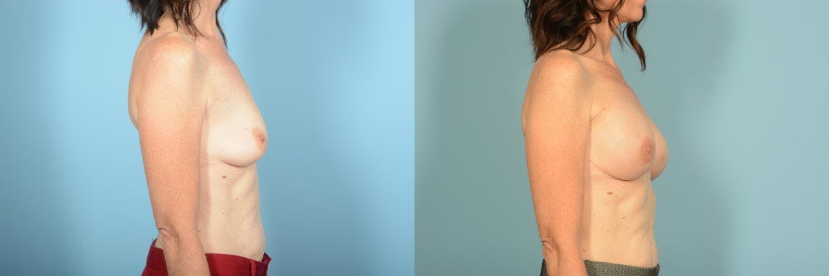 Genetic Mutations Before & After Gallery - Patient 275869 - Image 5