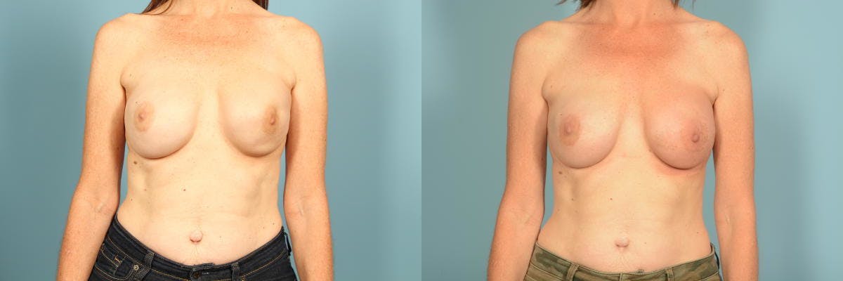 Genetic Mutations Before & After Gallery - Patient 275869 - Image 6