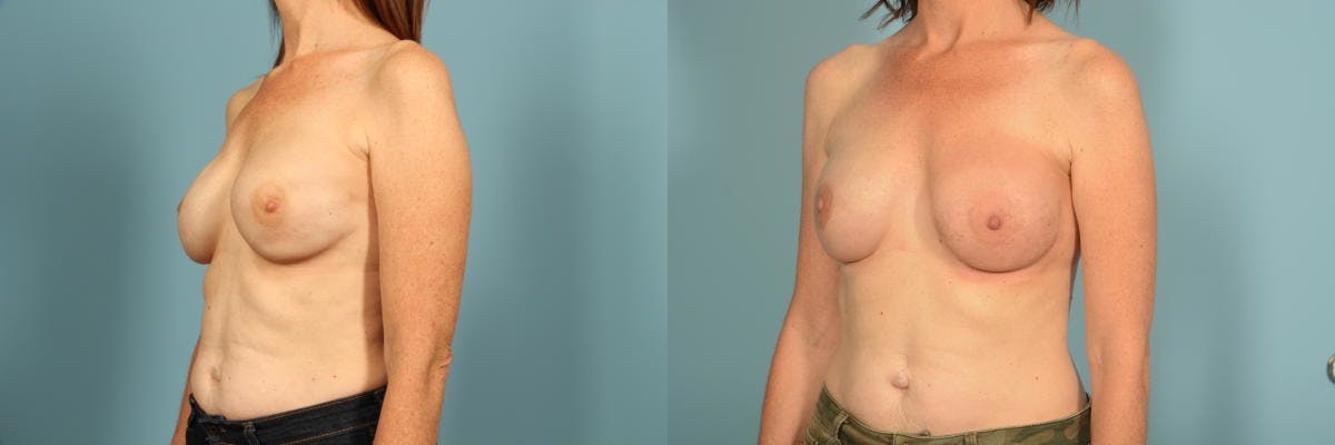 Genetic Mutations Before & After Gallery - Patient 275869 - Image 7
