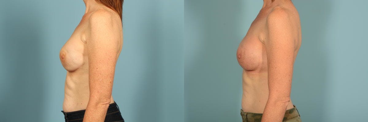Genetic Mutations Before & After Gallery - Patient 275869 - Image 9