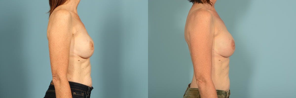 Genetic Mutations Before & After Gallery - Patient 275869 - Image 10