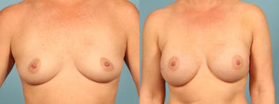 Genetic Mutations Before & After Gallery - Patient 531456 - Image 1