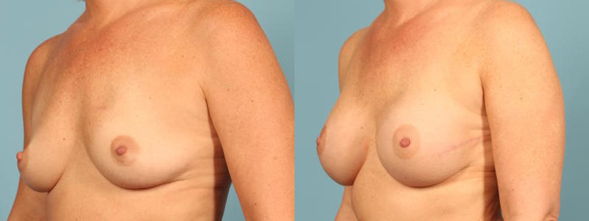 Genetic Mutations Before & After Gallery - Patient 531456 - Image 2