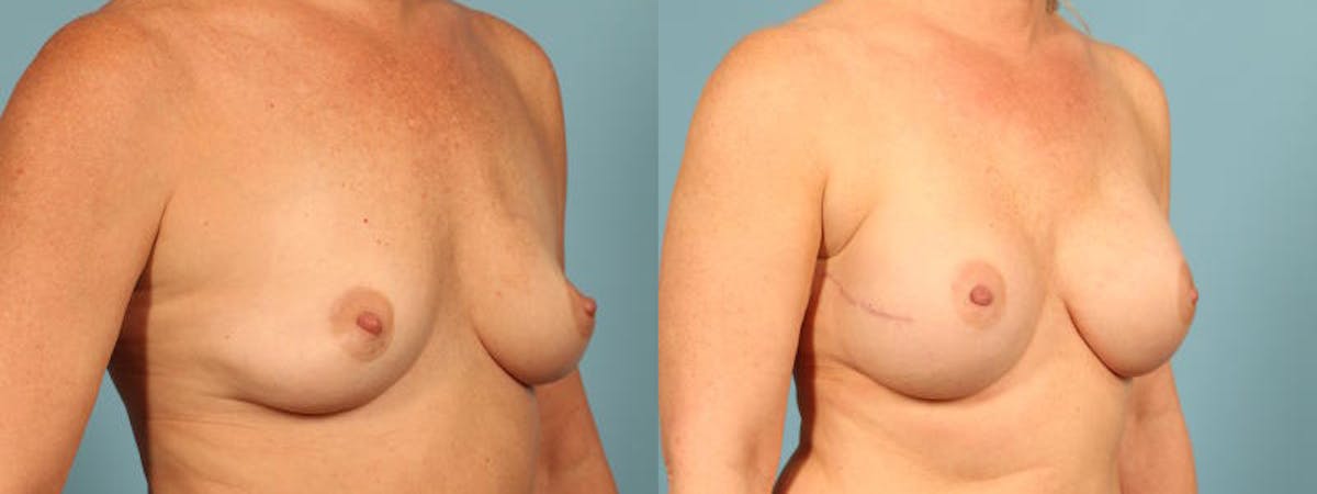 Genetic Mutations Before & After Gallery - Patient 531456 - Image 3