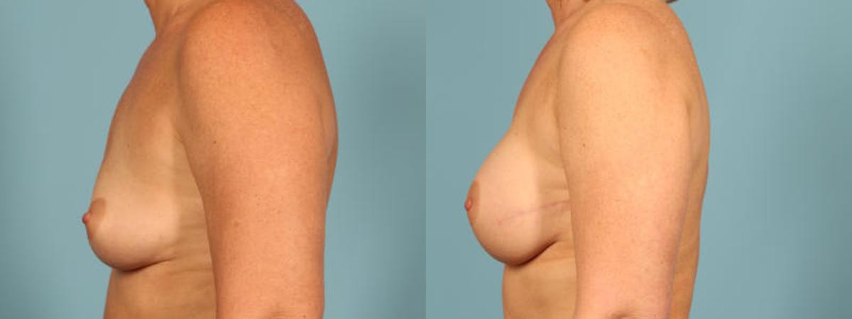 Genetic Mutations Before & After Gallery - Patient 531456 - Image 4