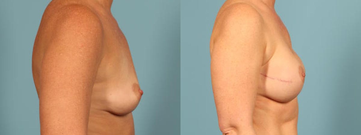 Genetic Mutations Before & After Gallery - Patient 531456 - Image 5