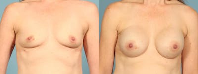 Genetic Mutations Before & After Gallery - Patient 698956 - Image 1