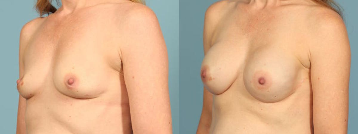 Genetic Mutations Before & After Gallery - Patient 698956 - Image 2