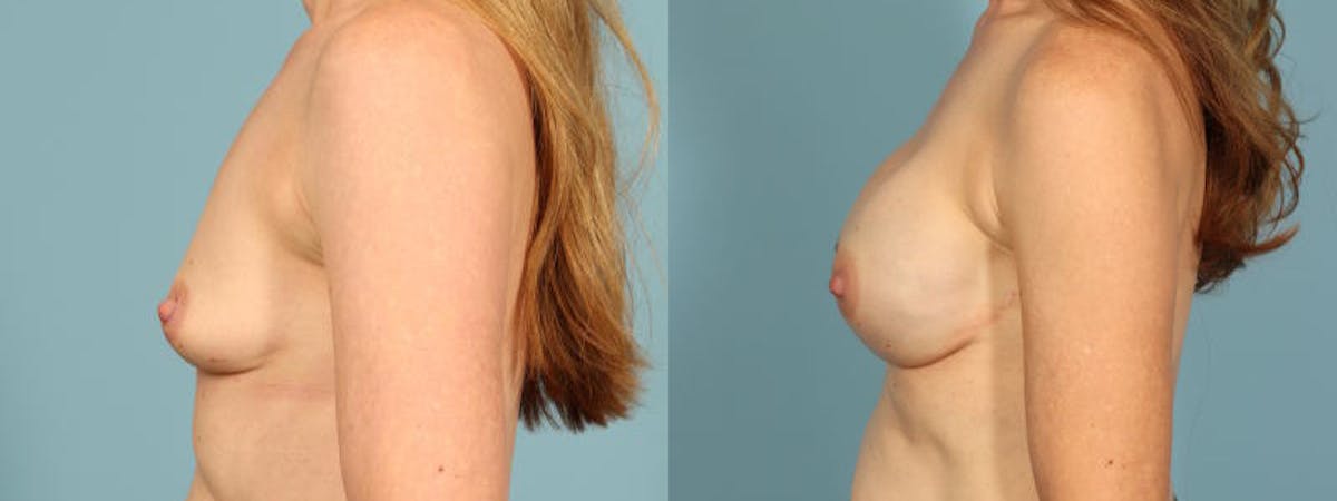 Genetic Mutations Before & After Gallery - Patient 698956 - Image 4