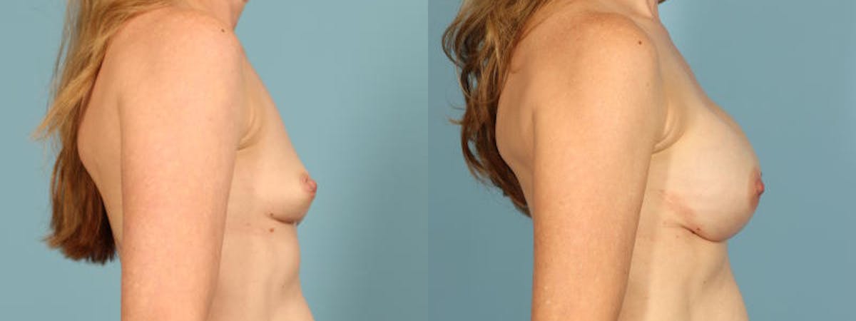 Genetic Mutations Before & After Gallery - Patient 698956 - Image 5