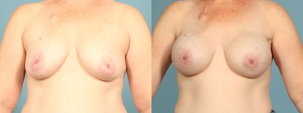 Genetic Mutations Before & After Gallery - Patient 186561 - Image 1