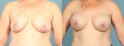 Genetic Mutations Before & After Gallery - Patient 186561 - Image 1