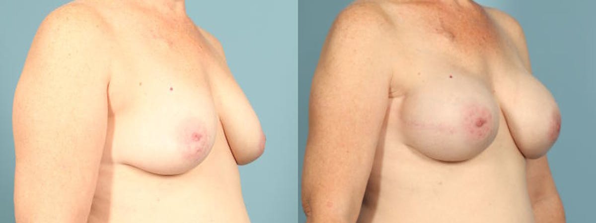 Genetic Mutations Before & After Gallery - Patient 186561 - Image 3