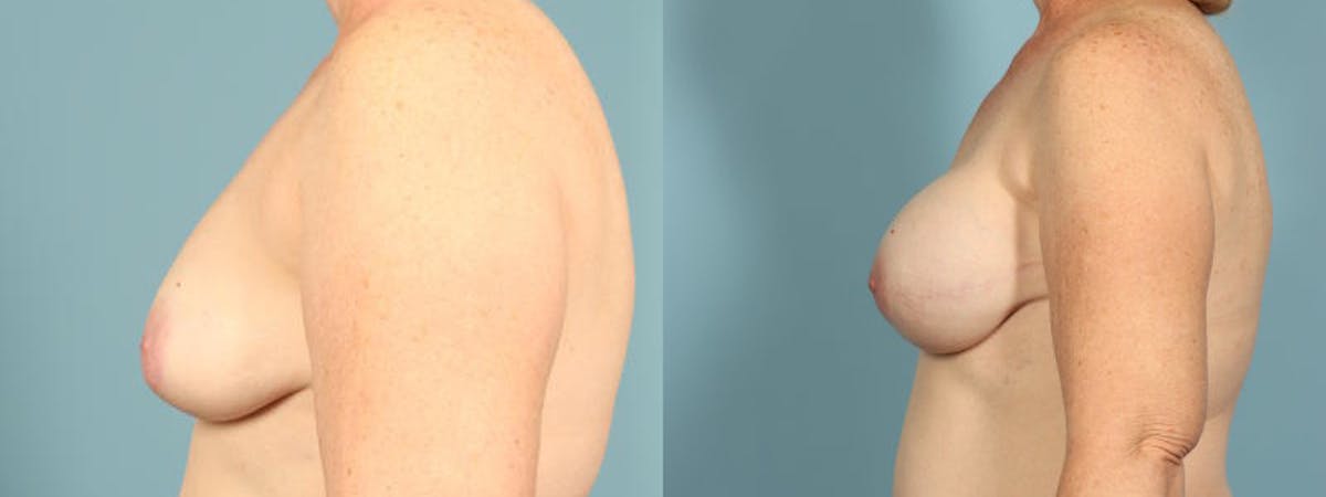 Genetic Mutations Before & After Gallery - Patient 186561 - Image 4