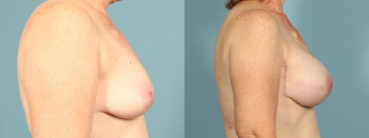 Genetic Mutations Before & After Gallery - Patient 186561 - Image 5