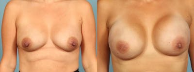 Genetic Mutations Before & After Gallery - Patient 165464 - Image 1