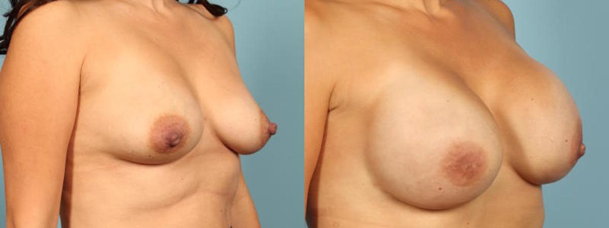 Genetic Mutations Before & After Gallery - Patient 165464 - Image 3