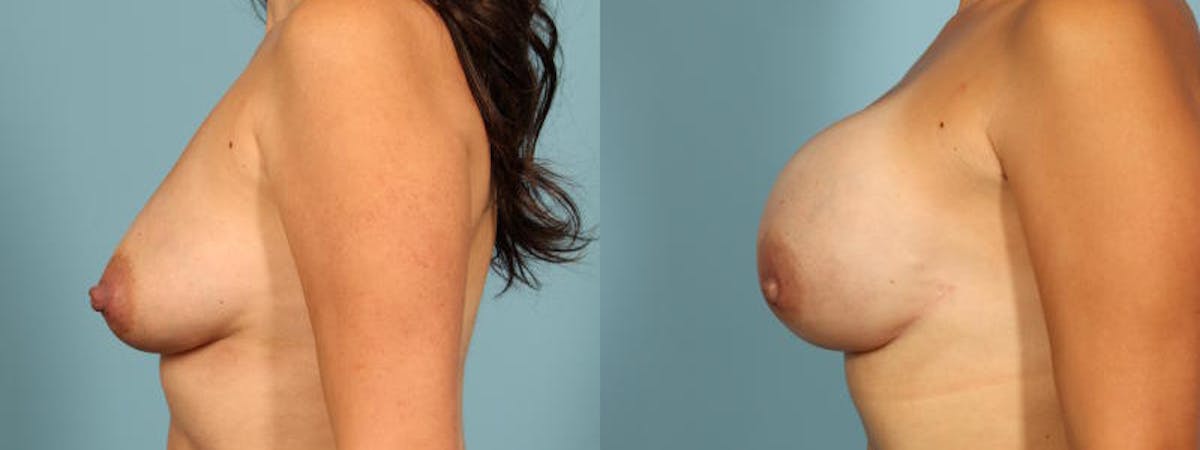Genetic Mutations Before & After Gallery - Patient 165464 - Image 4
