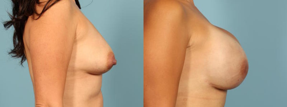 Genetic Mutations Before & After Gallery - Patient 165464 - Image 5