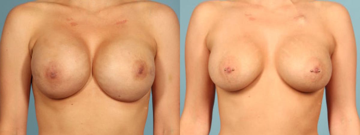 Genetic Mutations Before & After Gallery - Patient 304750 - Image 1