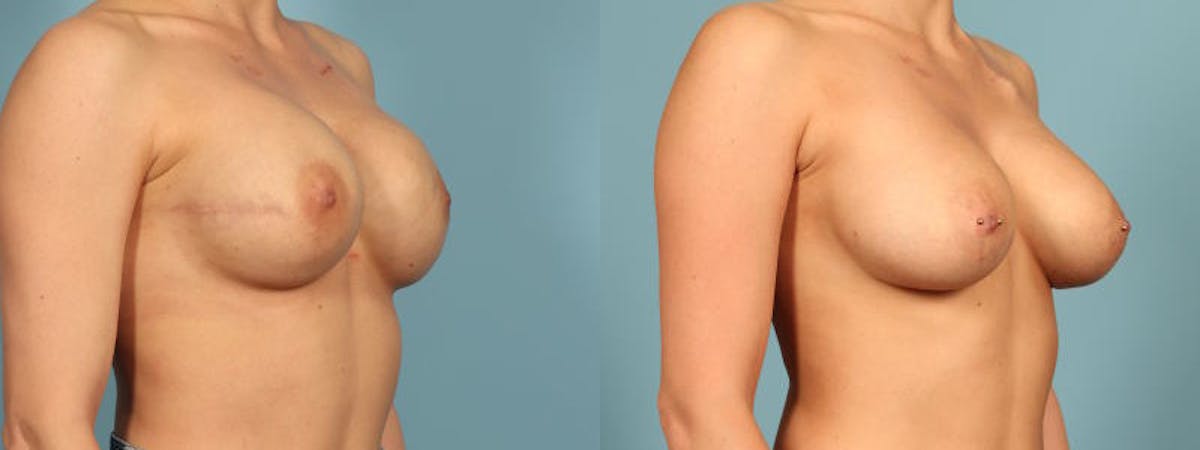Genetic Mutations Before & After Gallery - Patient 304750 - Image 2