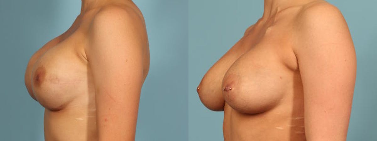 Genetic Mutations Before & After Gallery - Patient 304750 - Image 3