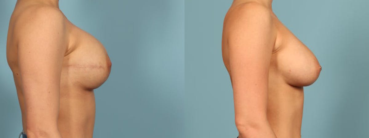Genetic Mutations Before & After Gallery - Patient 304750 - Image 4