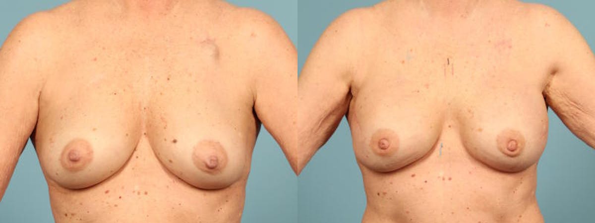 Genetic Mutations Before & After Gallery - Patient 604694 - Image 1