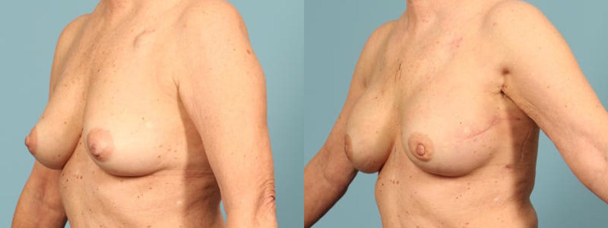 Genetic Mutations Before & After Gallery - Patient 604694 - Image 2