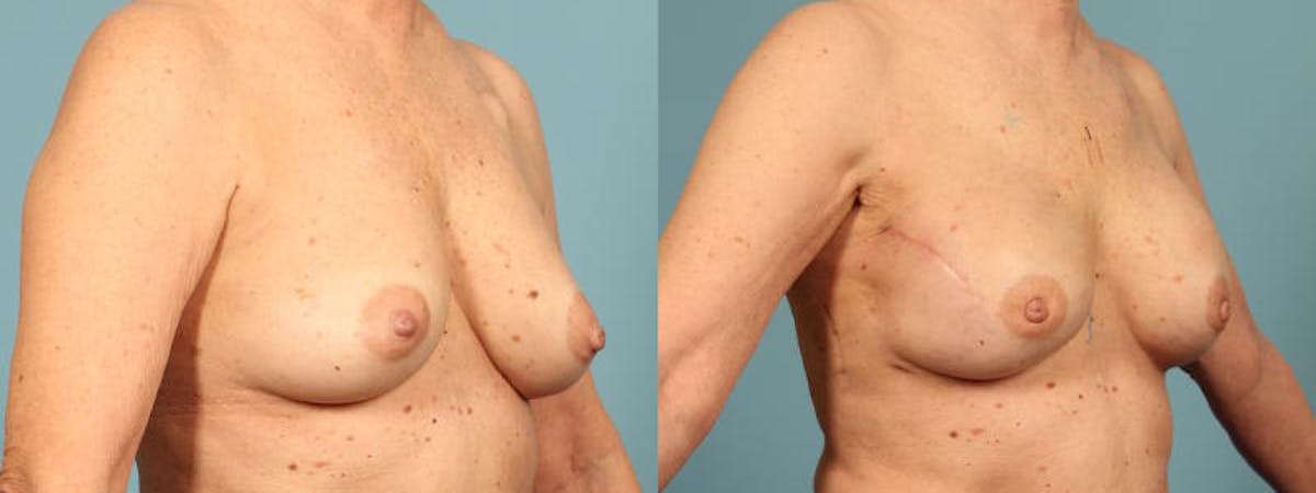 Genetic Mutations Before & After Gallery - Patient 604694 - Image 3