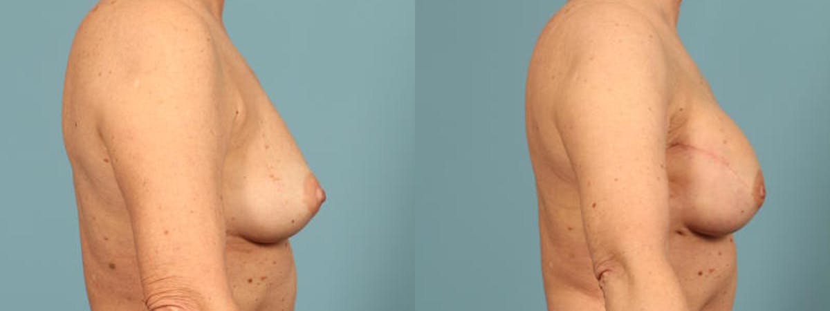 Genetic Mutations Before & After Gallery - Patient 604694 - Image 4