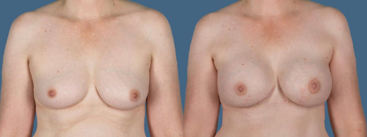 Direct to Implant Reconstruction Before & After Gallery - Patient 257224 - Image 1