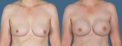 Genetic Mutations Before & After Gallery - Patient 160462 - Image 1